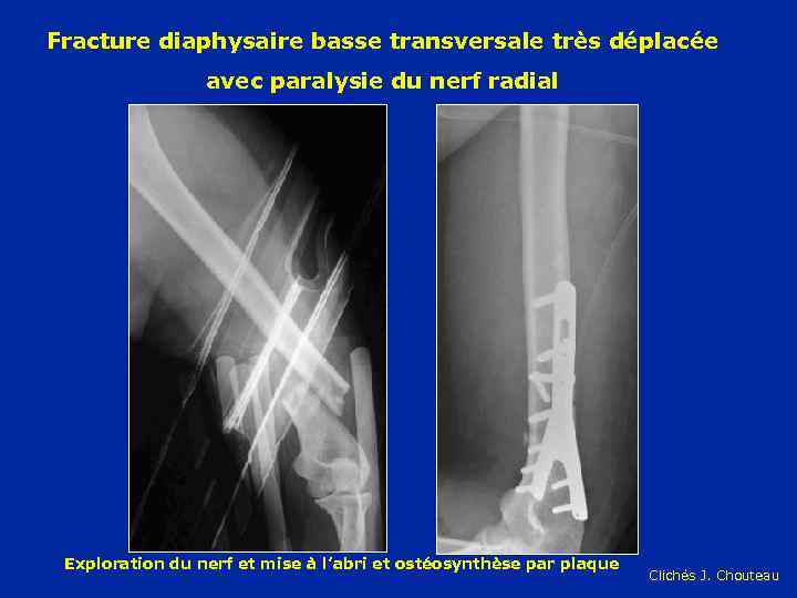 Fracture diaphysaire basse transversale très déplacée avec paralysie du nerf radial Exploration du nerf
