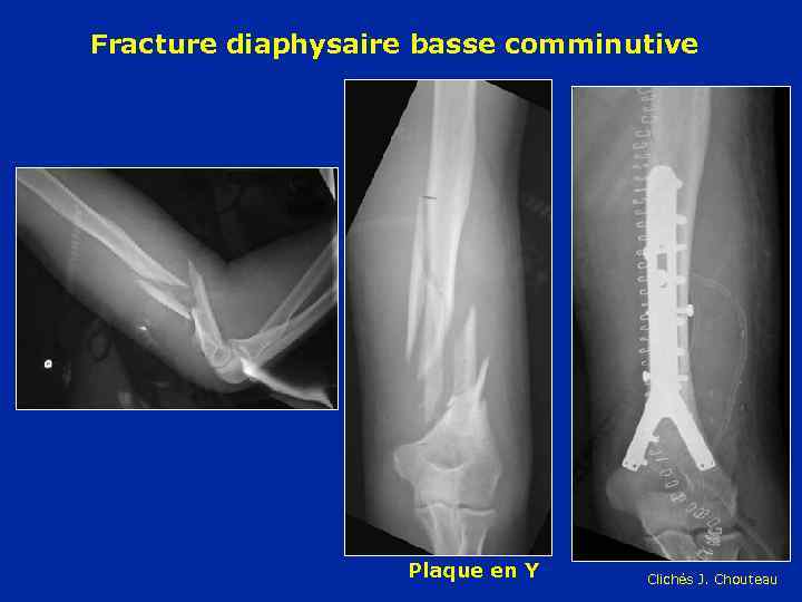 Fracture diaphysaire basse comminutive Plaque en Y Clichés J. Chouteau 