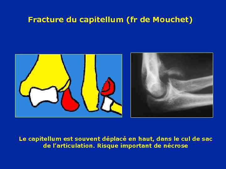 Fracture du capitellum (fr de Mouchet) Le capitellum est souvent déplacé en haut, dans
