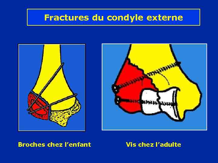 Fractures du condyle externe Broches chez l’enfant Vis chez l’adulte 