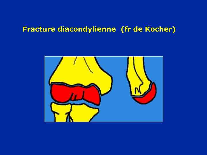 Fracture diacondylienne (fr de Kocher) 