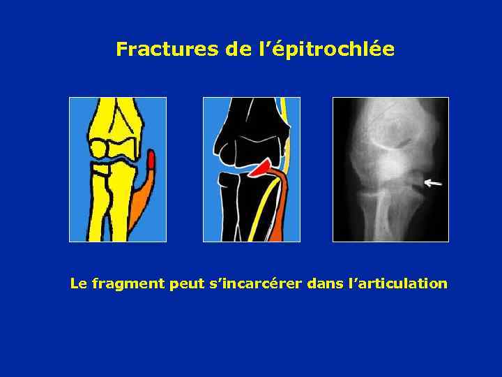 Fractures de l’épitrochlée Le fragment peut s’incarcérer dans l’articulation 