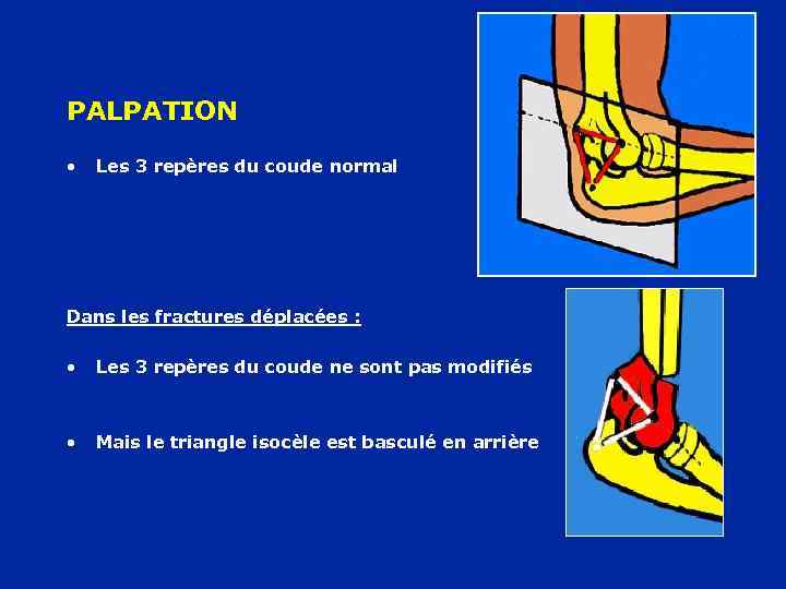 PALPATION • Les 3 repères du coude normal Dans les fractures déplacées : •