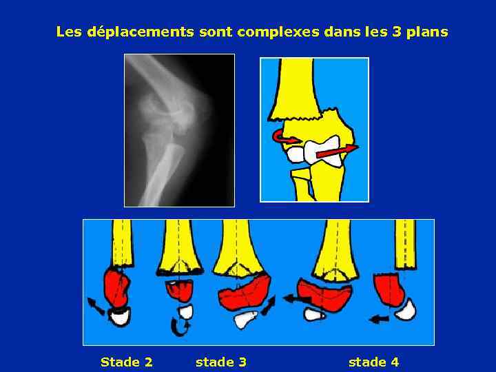 Les déplacements sont complexes dans les 3 plans Stade 2 stade 3 stade 4