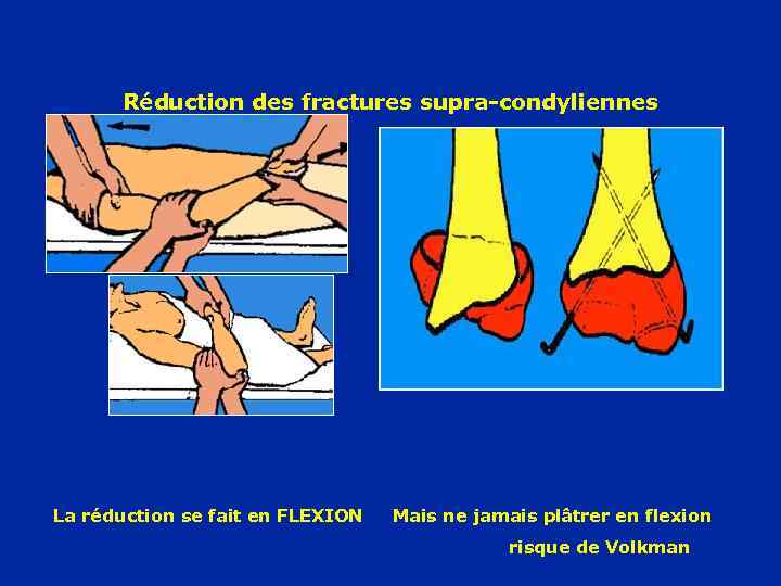 Réduction des fractures supra-condyliennes La réduction se fait en FLEXION Mais ne jamais plâtrer