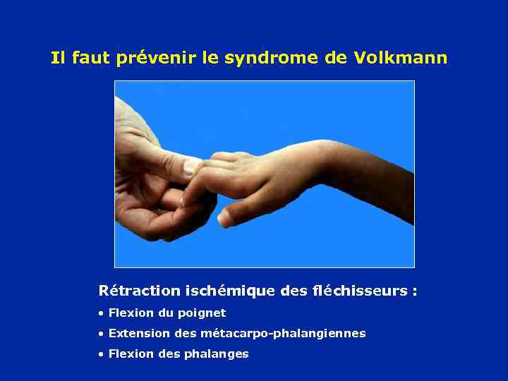 Il faut prévenir le syndrome de Volkmann Rétraction ischémique des fléchisseurs : • Flexion
