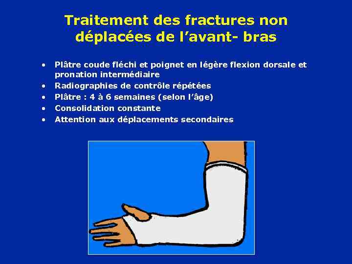 Traitement des fractures non déplacées de l’avant- bras • • • Plâtre coude fléchi