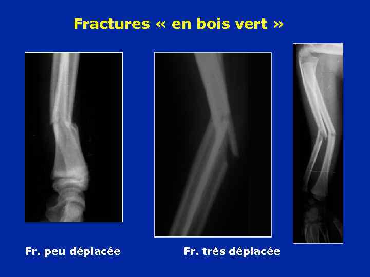 Fractures « en bois vert » Fr. peu déplacée Fr. très déplacée 