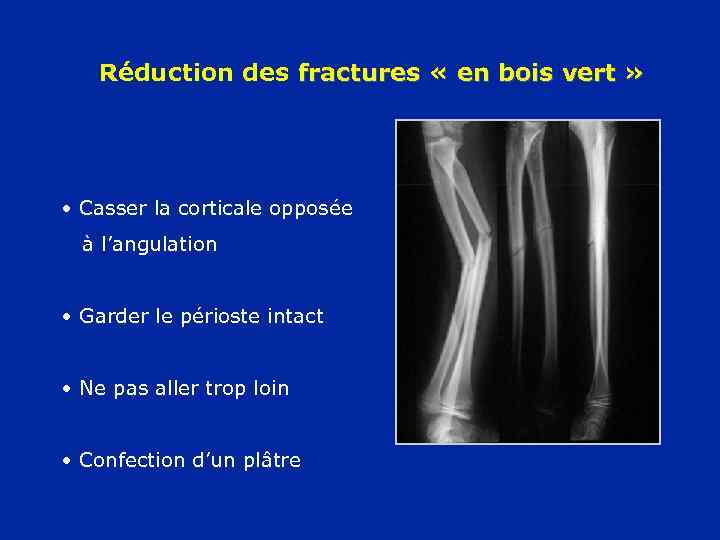 Réduction des fractures « en bois vert » • Casser la corticale opposée à