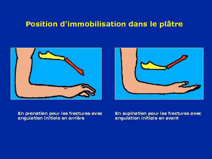 Position d’immobilisation dans le plâtre En pronation pour les fractures avec angulation initiale en