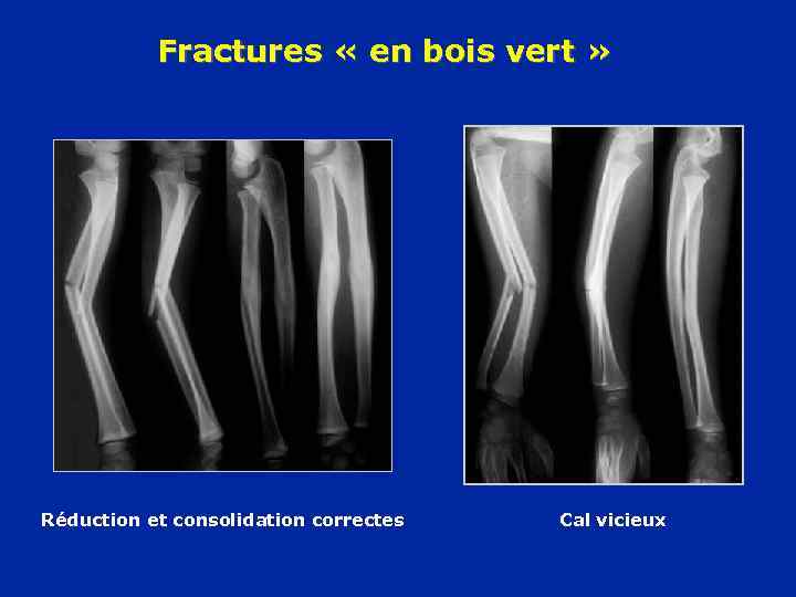 Fractures « en bois vert » Réduction et consolidation correctes Cal vicieux 