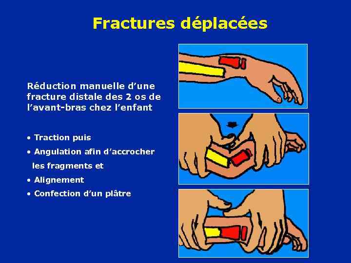 Fractures déplacées Réduction manuelle d’une fracture distale des 2 os de l’avant-bras chez l’enfant