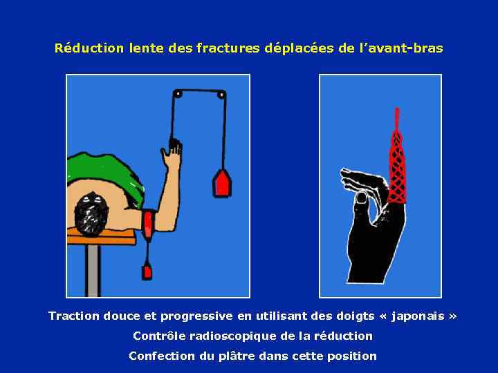 Réduction lente des fractures déplacées de l’avant-bras Traction douce et progressive en utilisant des