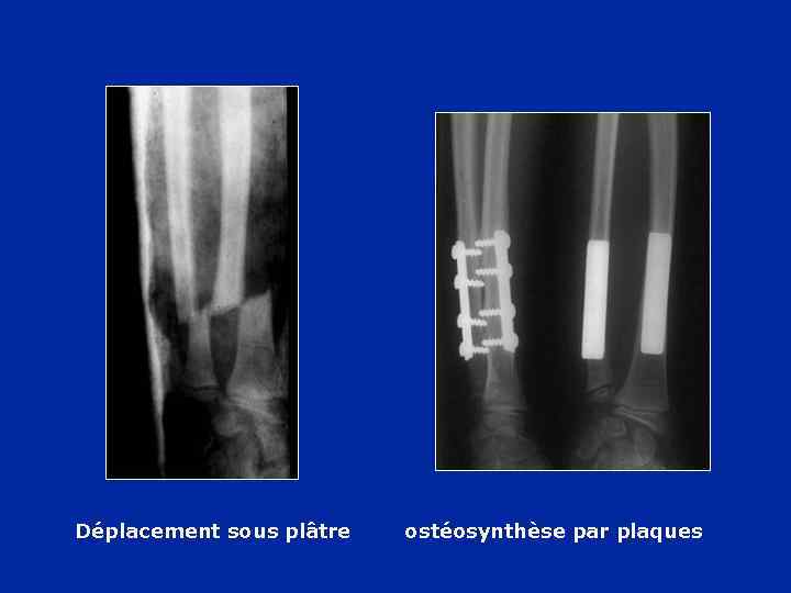 Déplacement sous plâtre ostéosynthèse par plaques 