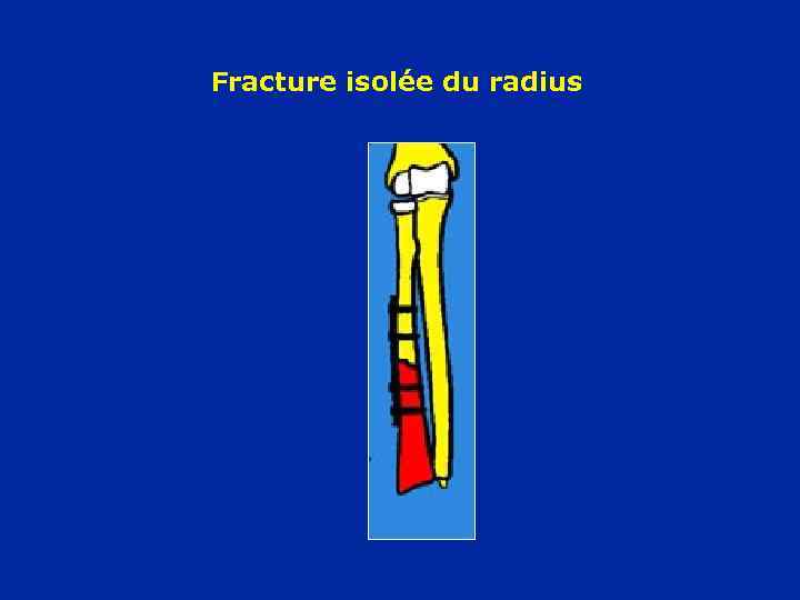 Fracture isolée du radius 