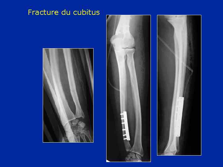 Fracture du cubitus 