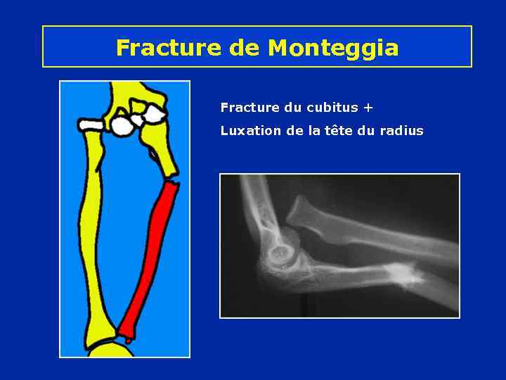 Fracture de Monteggia Fracture du cubitus + Luxation de la tête du radius 