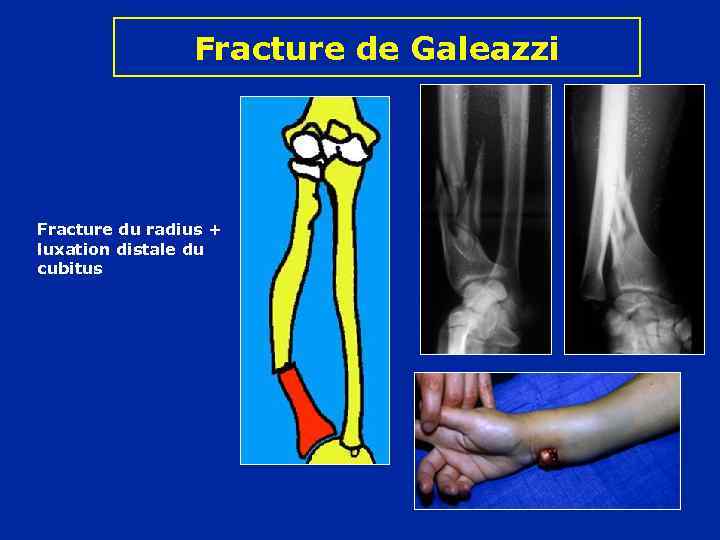 Fracture de Galeazzi Fracture du radius + luxation distale du cubitus 