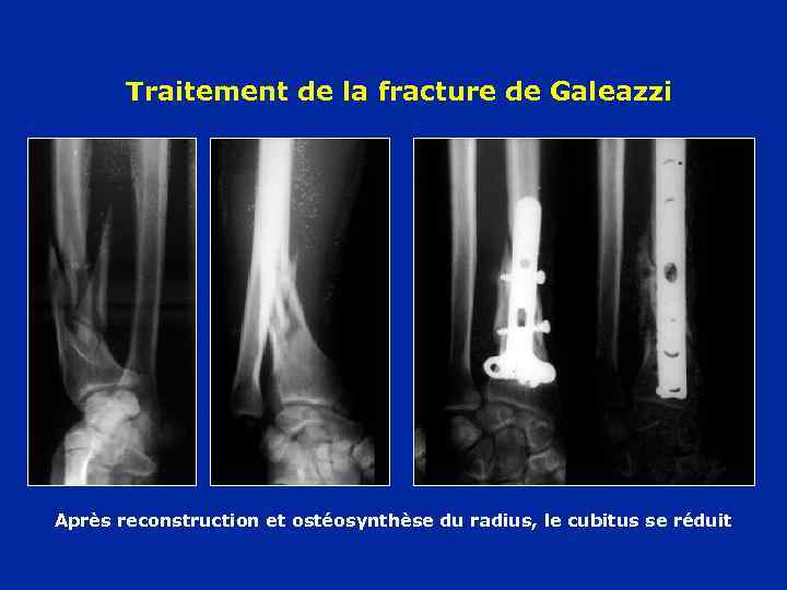 Traitement de la fracture de Galeazzi Après reconstruction et ostéosynthèse du radius, le cubitus