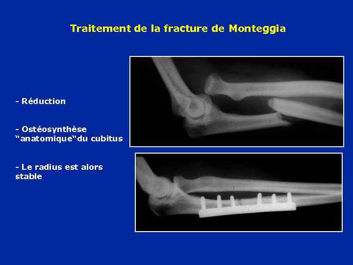 Traitement de la fracture de Monteggia - Réduction - Ostéosynthèse “anatomique“du cubitus - Le