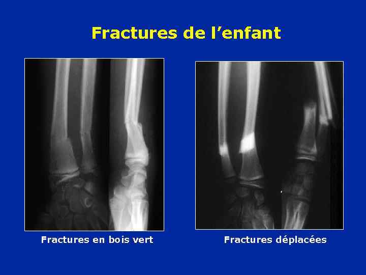 Fractures de l’enfant Fractures en bois vert Fractures déplacées 