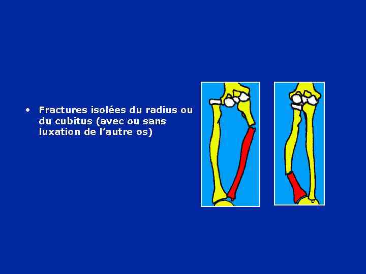  • Fractures isolées du radius ou du cubitus (avec ou sans luxation de