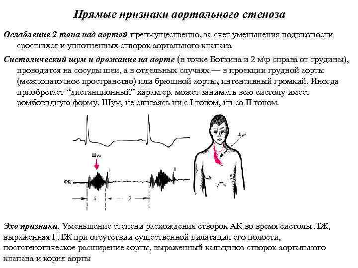 Прямые признаки аортального стеноза Ослабление 2 тона над аортой преимущественно, за счет уменьшения подвижности