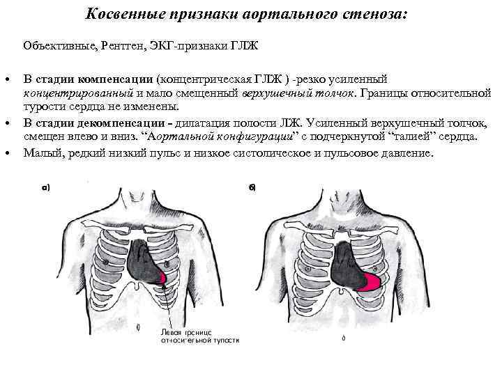Косвенные признаки аортального стеноза: Объективные, Рентген, ЭКГ-признаки ГЛЖ • • • В стадии компенсации