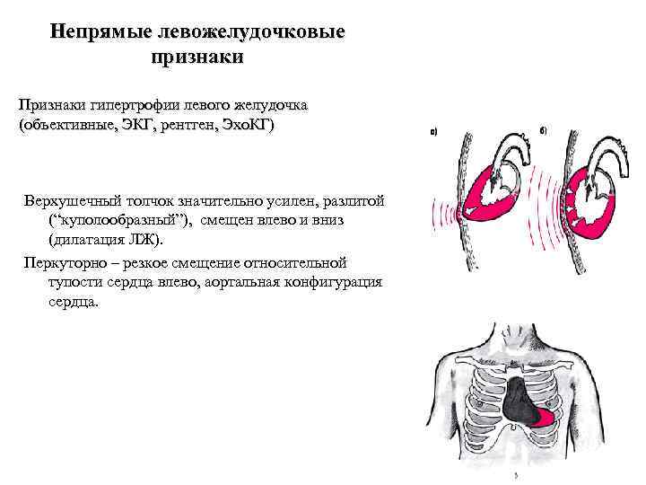 Непрямые левожелудочковые признаки Признаки гипертрофии левого желудочка (объективные, ЭКГ, рентген, Эхо. КГ) Верхушечный толчок