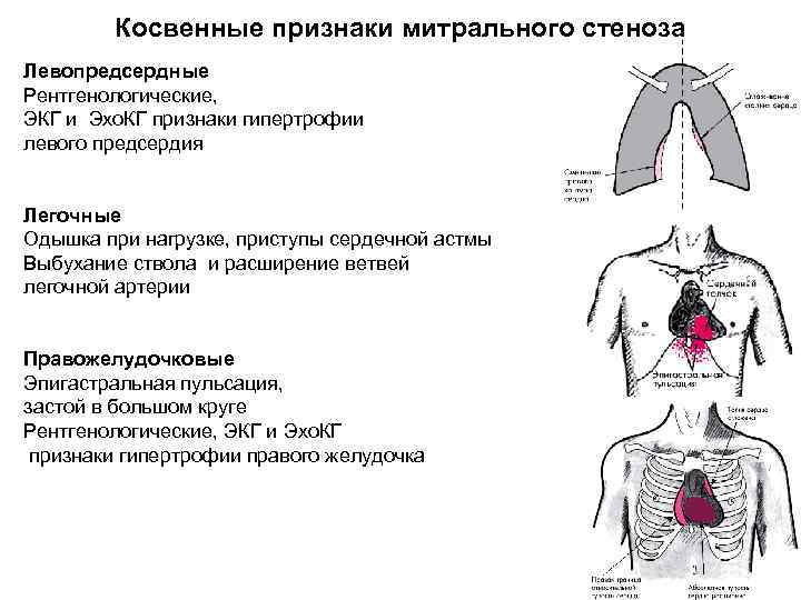 Косвенные признаки митрального стеноза Левопредсердные Рентгенологические, ЭКГ и Эхо. КГ признаки гипертрофии левого предсердия