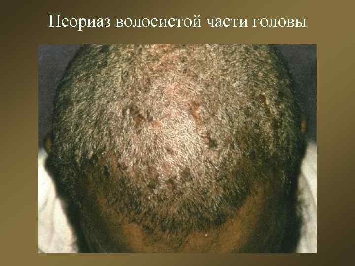 Псориаз волосистой части головы 