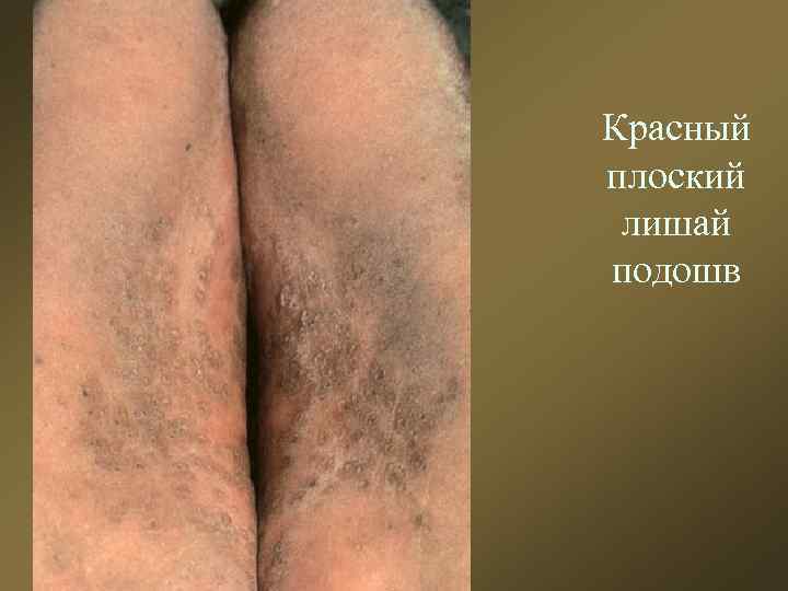 Красный плоский лишай подошв 