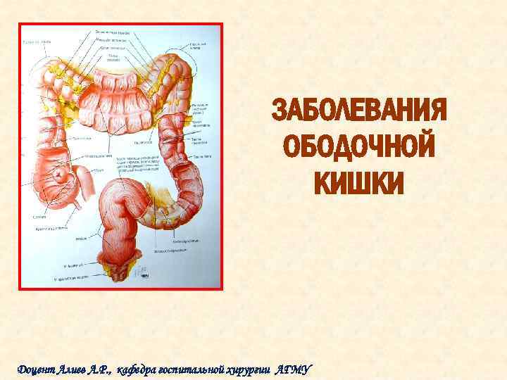 ЗАБОЛЕВАНИЯ ОБОДОЧНОЙ КИШКИ Доцент Алиев А. Р. , кафедра госпитальной хирургии АГМУ 