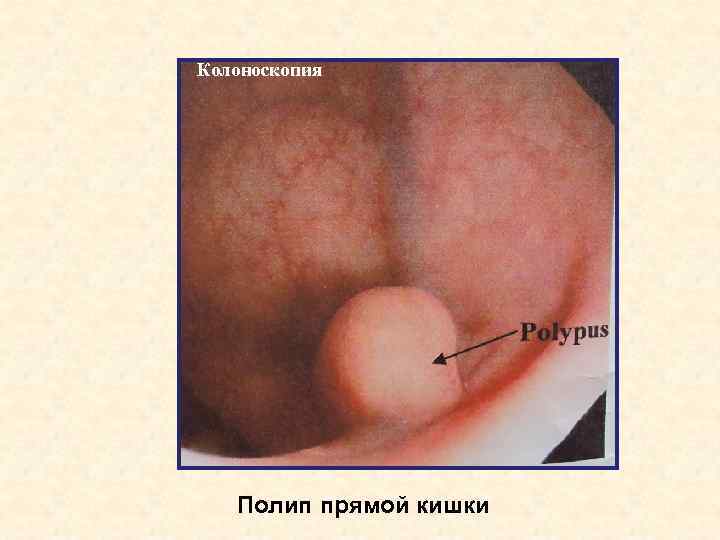 Колоноскопия Полип прямой кишки 