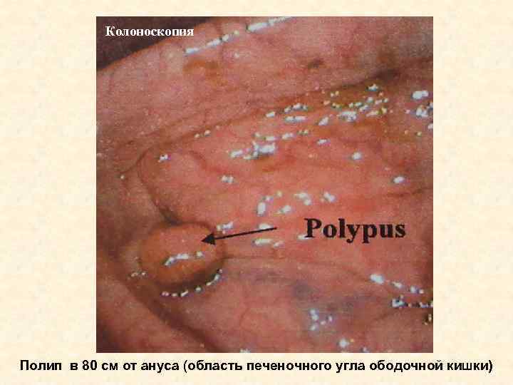 Колоноскопия Полип в 80 см от ануса (область печеночного угла ободочной кишки) 