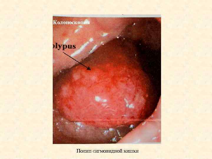 Колоноскопия Полип сигмовидной кишки 