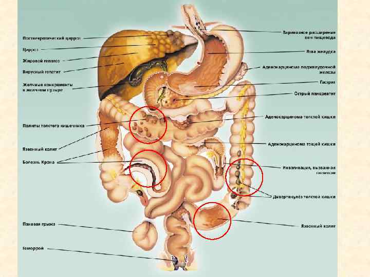 Заболевания прямой и ободочной кишки презентация