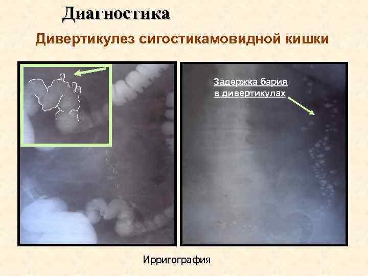 Диагностика Дивертикулез сигостикамовидной кишки Задержка бария в дивертикулах Ирригография 