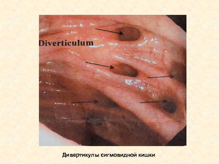Дивертикулы сигмовидной кишки 