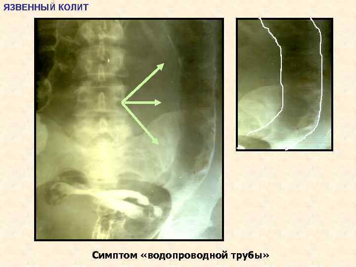 Язвенный колит симптомы. Водопроводная труба няк. Неспецифический язвенный колит рентген. Симптом водопроводной трубы рентген. Язвенный колит исчезновение гаустрации.