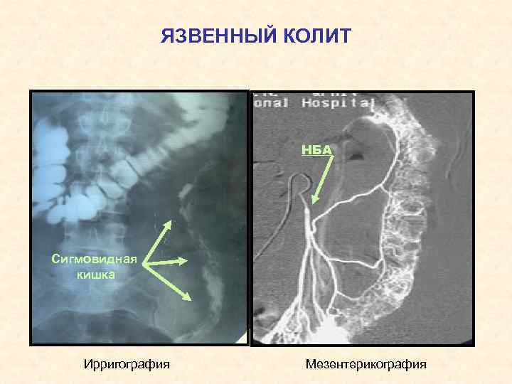 ЯЗВЕННЫЙ КОЛИТ НБА Сигмовидная кишка Ирригография Мезентерикография 