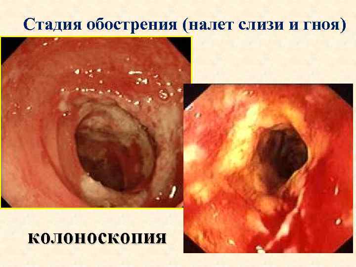 Стадия обострения (налет слизи и гноя) колоноскопия 