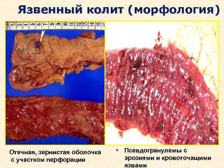 Язвенный колит (морфология) Отечная, зернистая оболочка с участком перфорации • Псевдогранулемы с эрозиями и