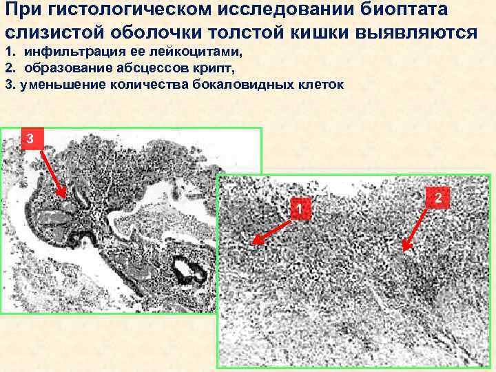 При гистологическом исследовании биоптата слизистой оболочки толстой кишки выявляются 1. инфильтрация ее лейкоцитами, 2.