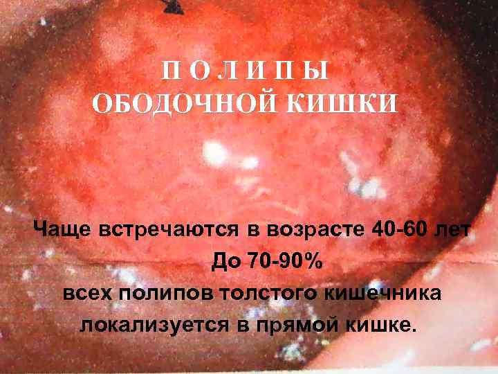 ПОЛИПЫ ОБОДОЧНОЙ КИШКИ Чаще встречаются в возрасте 40 -60 лет До 70 -90% всех