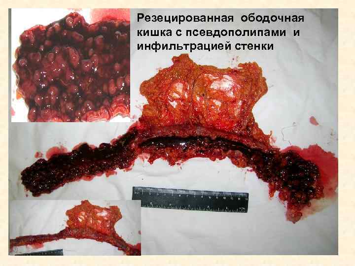 Резецированная ободочная кишка с псевдополипами и инфильтрацией стенки 