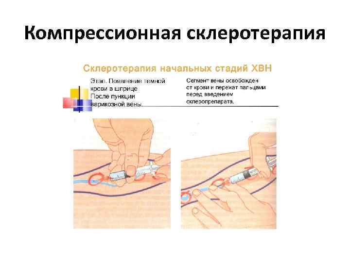 Компрессионная склеротерапия 