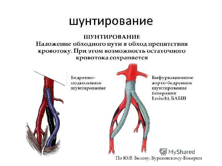 шунтирование 