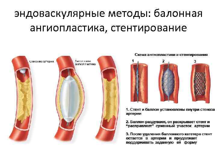 эндоваскулярные методы: балонная ангиопластика, стентирование 