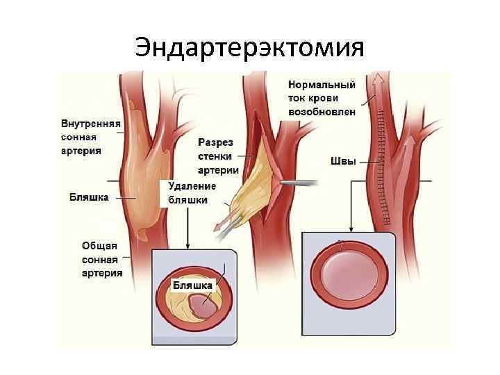 Эндартерэктомия 